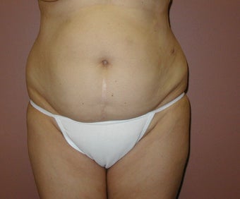 Tummy tuck with Flank Liposuction before 1208048