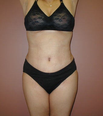 Tummy tuck with Flank Liposuction after 1208048