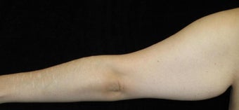 26 year old woman treated with Arm Lift and Liposuction After Weight Loss 3251860