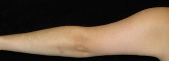 26 year old woman treated with Arm Lift and Liposuction After Weight Loss 3251860
