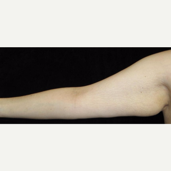 26 year old woman treated with Arm Lift and Liposuction After Weight Loss before 3251860