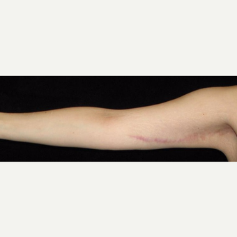 26 year old woman treated with Arm Lift and Liposuction After Weight Loss after 3251860