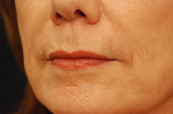 Restylane after 149904