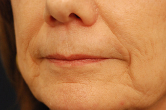 Restylane before 149904