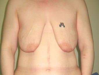 25-34 year old woman treated with Breast Lift before 1536095