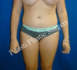 18-24 year old woman treated with Tummy Tuck after 3765019