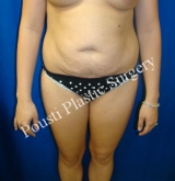 18-24 year old woman treated with Tummy Tuck before 3765019