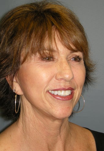 LiteLift™ and Platysmaplasty on 62-year-old Woman after 387671