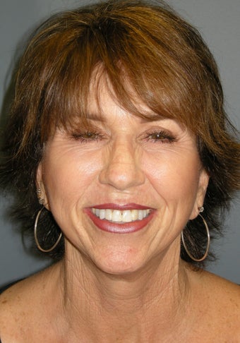 LiteLift™ and Platysmaplasty on 62-year-old Woman 387671