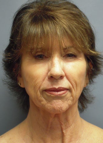 LiteLift™ and Platysmaplasty on 62-year-old Woman 387671