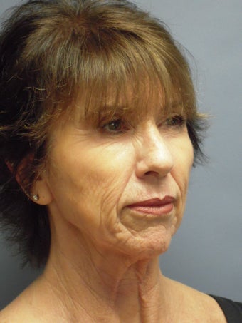 LiteLift™ and Platysmaplasty on 62-year-old Woman before 387671