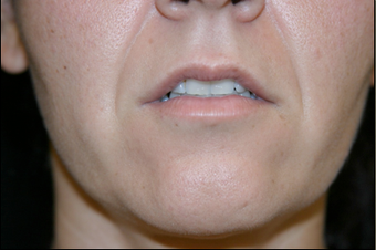 Upper Lip Lift or Lips before 725806