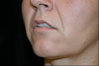 Upper Lip Lift or Lips 725806