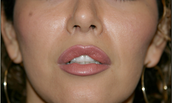 Upper Lip Lift or Lips after 725806