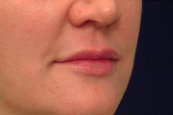 Injectable Filler after 149358