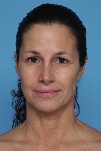 BrowLift before 996091