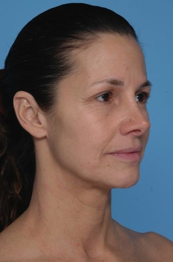 BrowLift 996091