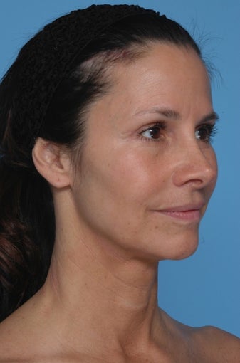 BrowLift 996091