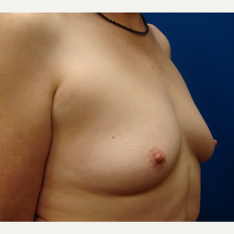 55-64 year old woman treated with Breast Implants before 3669431