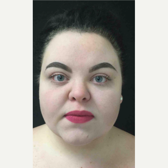 25-34 year old woman treated with Laser Liposuction after 3200236