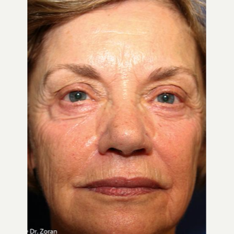 65-74 year old woman treated with Eyelid Surgery before 3093452
