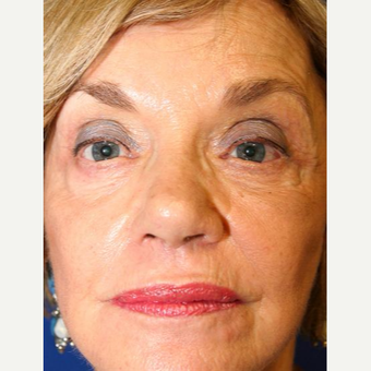 65-74 year old woman treated with Eyelid Surgery after 3093452