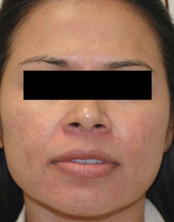 Rosacea Treatment with Lasers after 106550
