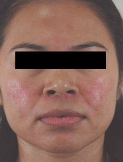 Rosacea Treatment with Lasers before 106550