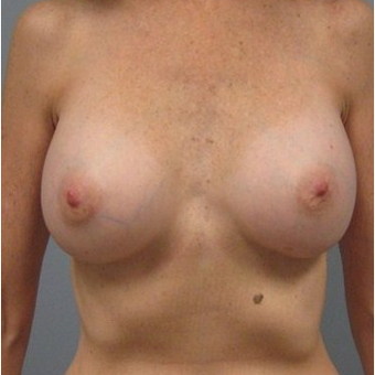 Breast Reconstruction after 3468170
