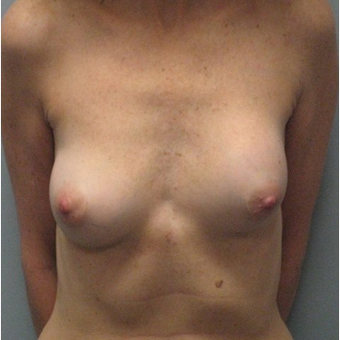Breast Reconstruction before 3468170