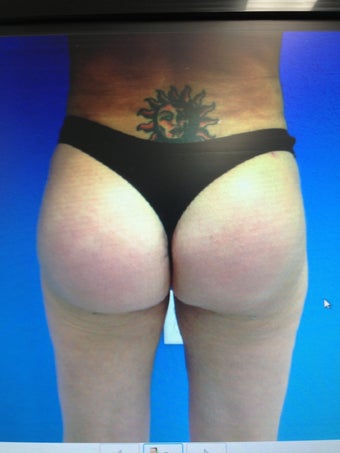 Gluteal Augmentation with silicone implants and fat grafting combo after 1203994