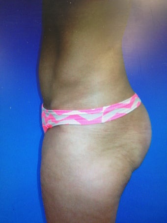 Gluteal Augmentation with silicone implants and fat grafting combo 1203994