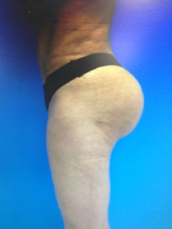 Gluteal Augmentation with silicone implants and fat grafting combo 1203994