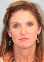 55-64 year old woman treated with Neck Lift before 3103875