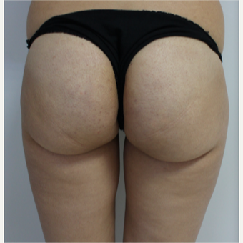 25-34 year old woman treated with Breast Augmentation before 3184621