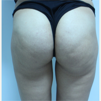 25-34 year old woman treated with Breast Augmentation after 3184621