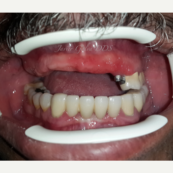 Implant supported Overdenture before 3119765