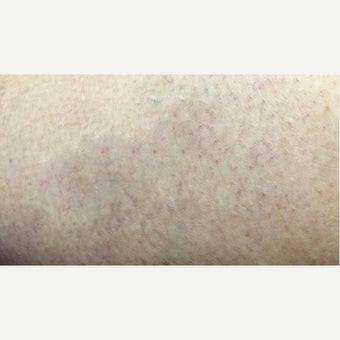 35-44 year old woman treated with Vein Treatment after 2565237