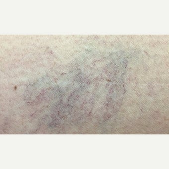 35-44 year old woman treated with Vein Treatment before 2565237