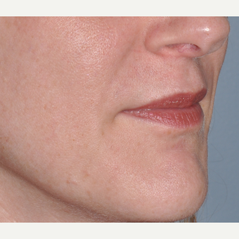 Facial Filler to Lower Face after 3374958