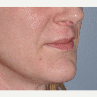 Facial Filler to Lower Face before 3374958