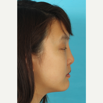 25-34 year old woman treated with Rhinoplasty after 3629190
