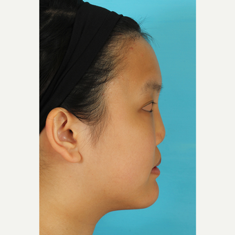 25-34 year old woman treated with Rhinoplasty before 3629190