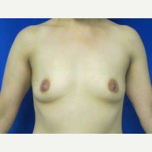 Breast Augmentation before 3054757
