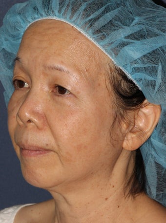 50 year old Asian female treated for brown spots and age spots after 1058156