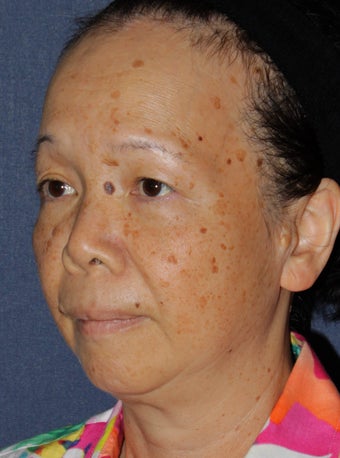 50 year old Asian female treated for brown spots and age spots before 1058156