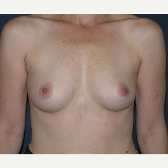 45-54 year old woman treated with Breast Augmentation before 3455529