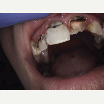 25-34 year old woman treated with Dental Crown before 2879805