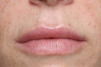 Lip treatment with Restylane® after 119340