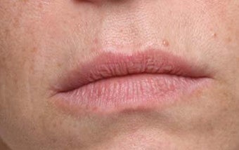 Lip treatment with Restylane® before 119340